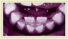Not the Six-Year-Old's mouth. This photo comes courtesy of the blog Pediatric Dentistry.